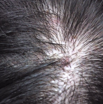 頭皮に出来た痛いニキビの原因と対処法のポイント7つ 抜け毛や薄毛 白髪や頭皮トラブルなど男性女性の髪の悩みを解決