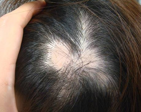 子供の円形脱毛症の原因とは 対策は早めに 抜け毛や薄毛 白髪や頭皮トラブルなど男性女性の髪の悩みを解決